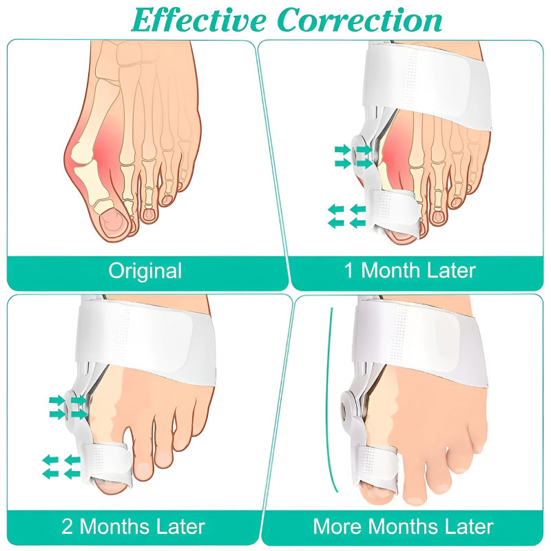 Bunion Splint and Big Toe Straightener – Orthopedic Hallux